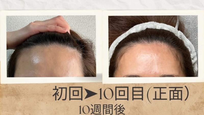 育毛施術のビフォーアフター